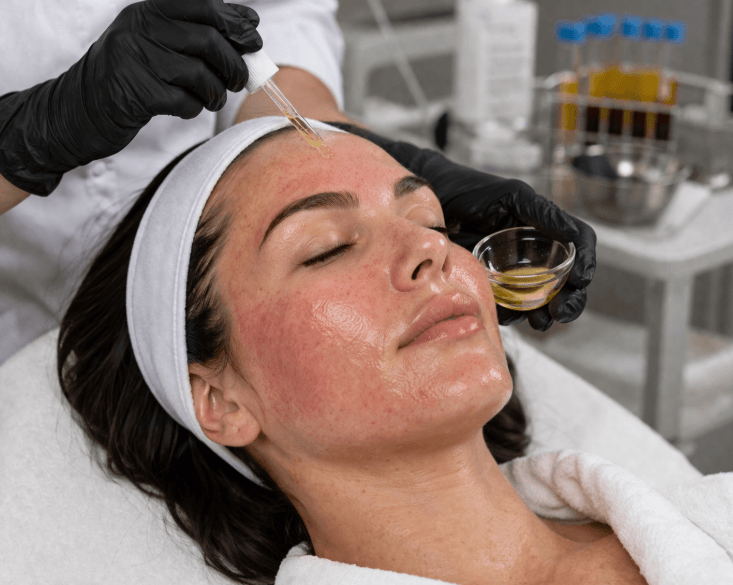 PRP for skin