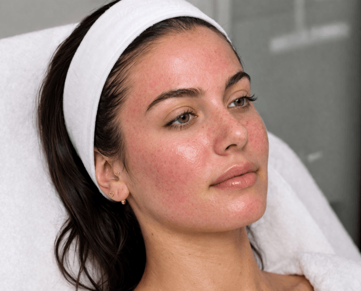 after PRP treatment