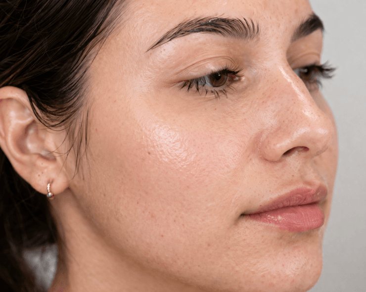 chemical peel after