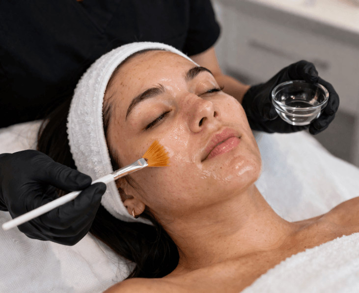 chemical peel facial