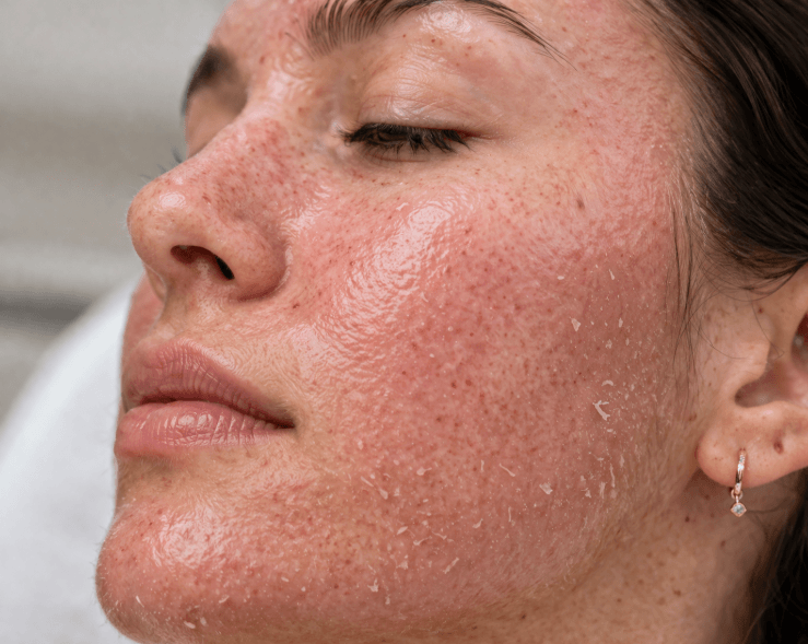 co2 laser treatment