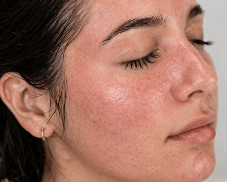 microneedling for skin